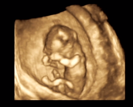 3d ultrasound scan. Scan above is the 3D scan